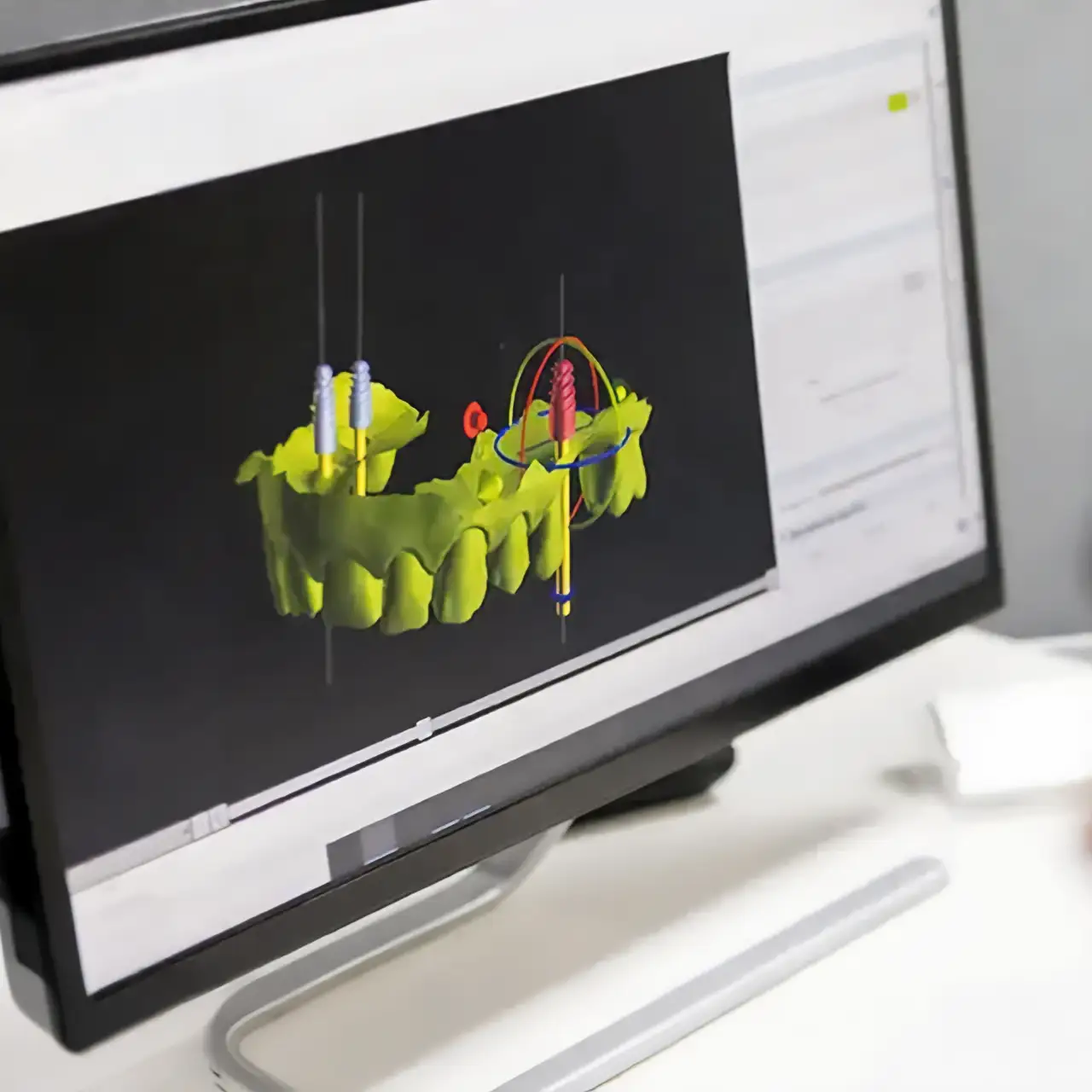 Diagnosi avanzata per un piano di trattamento su misura - 3d - Studio Dentistico a Olbia - Rehabilita - Dott.ri Farre e Tilli Diagnosi avanzata per un piano di trattamento su misura - 3d - Studio Dentistico a Olbia - Rehabilita - Dott.ri Farre e Tilli