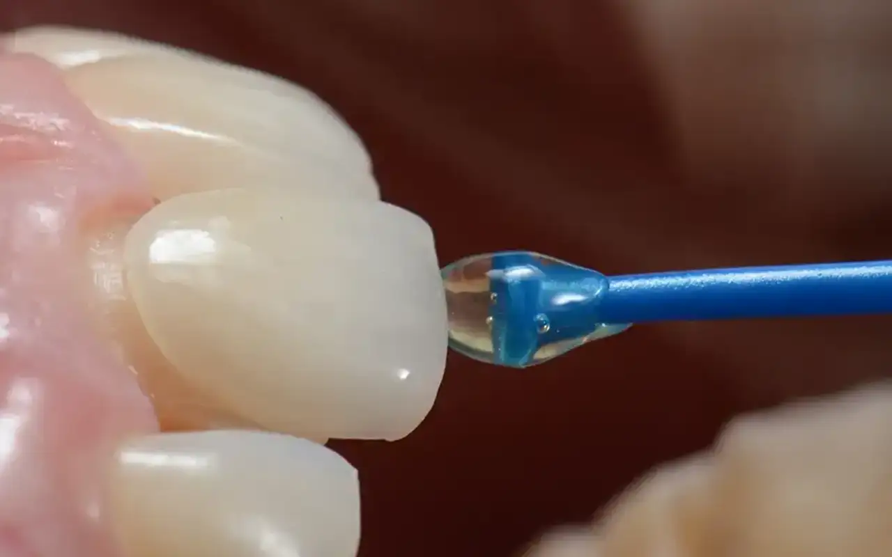Lavoriamo con faccette “prep” e “no-prep” - Studio Dentistico a Olbia - Rehabilita - Dott.ri Farre e Tilli