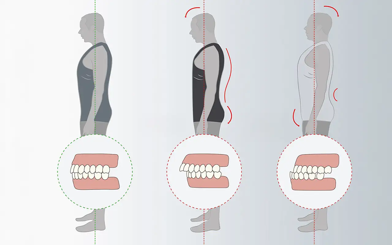 Postura Malocclusione - Studio Dentistico a Olbia - Rehabilita - Dott.ri Farre e Tilli Postura Malocclusione - Studio Dentistico a Olbia - Rehabilita - Dott.ri Farre e Tilli
