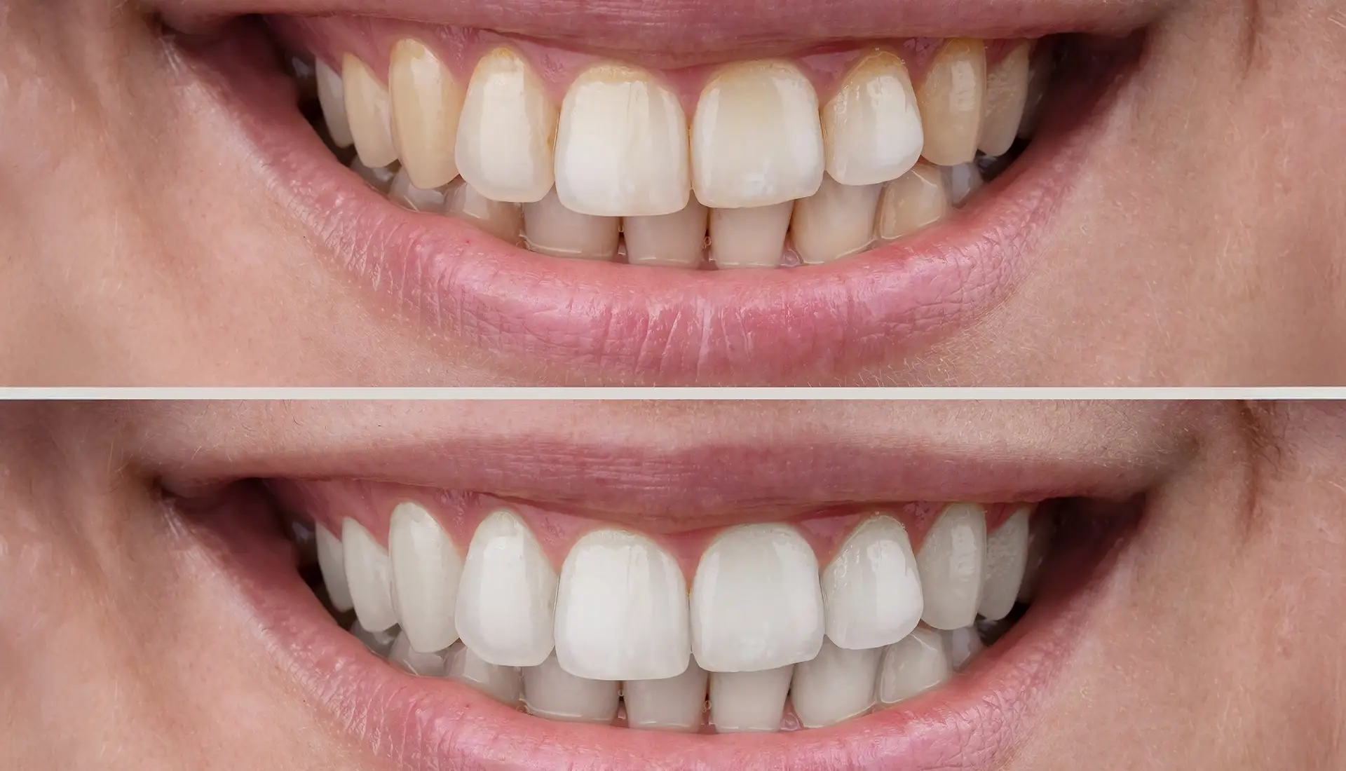 Igiene e Sbiancamento Dentale - Studio Dentistico a Olbia - Rehabilita - Dott.ri Farre e Tilli