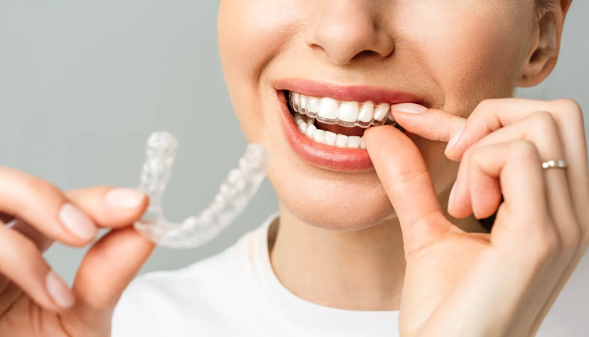 Ortodonzia trasparente - Studio Dentistico a Olbia - Rehabilita - Dott.ri Farre e Tilli