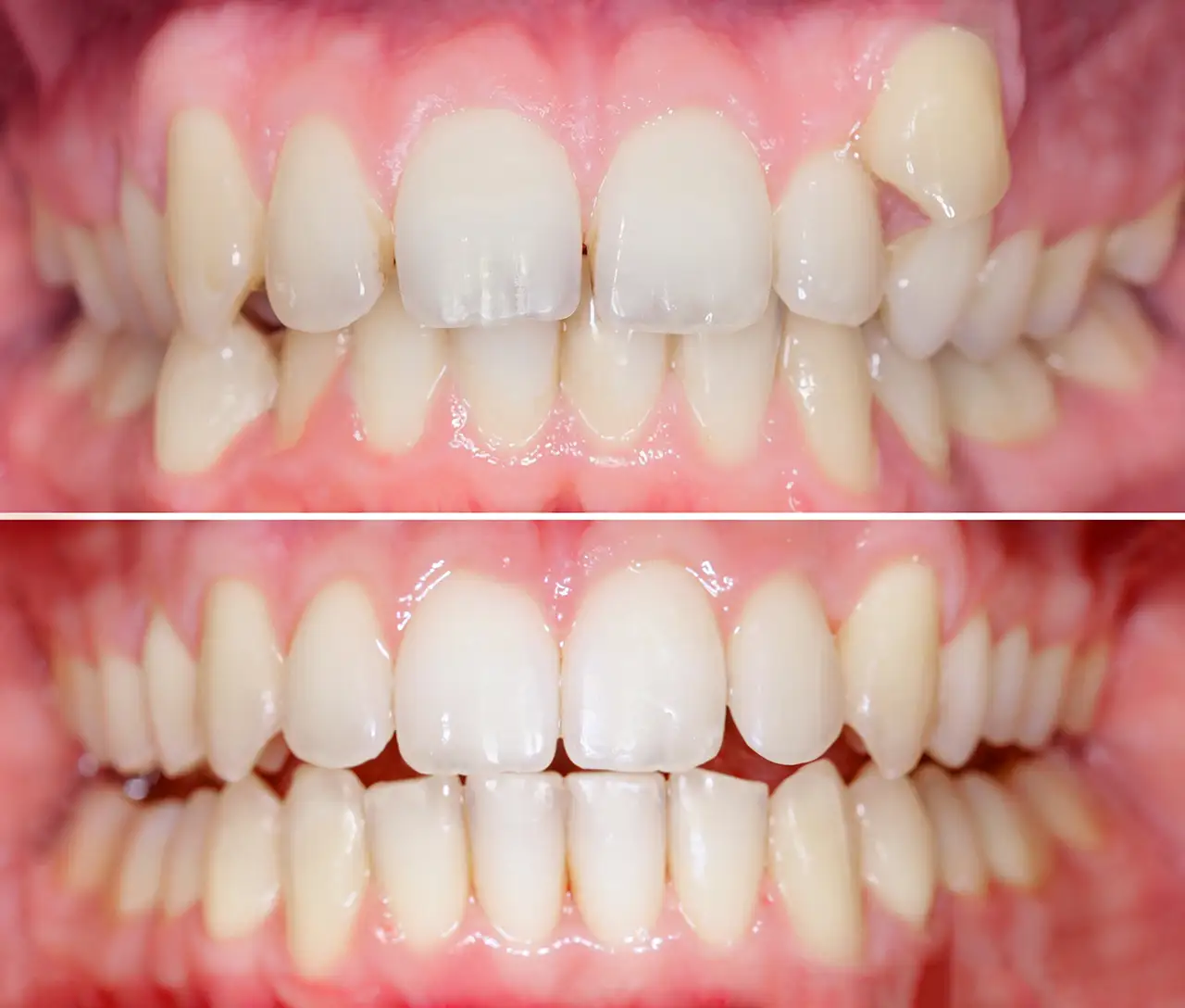 Perché sottoporsi a un trattamento ortodontico da adulti - Studio Dentistico a Olbia - Rehabilita - Dott.ri Farre e Tilli Perché sottoporsi a un trattamento ortodontico da adulti - Studio Dentistico a Olbia - Rehabilita - Dott.ri Farre e Tilli