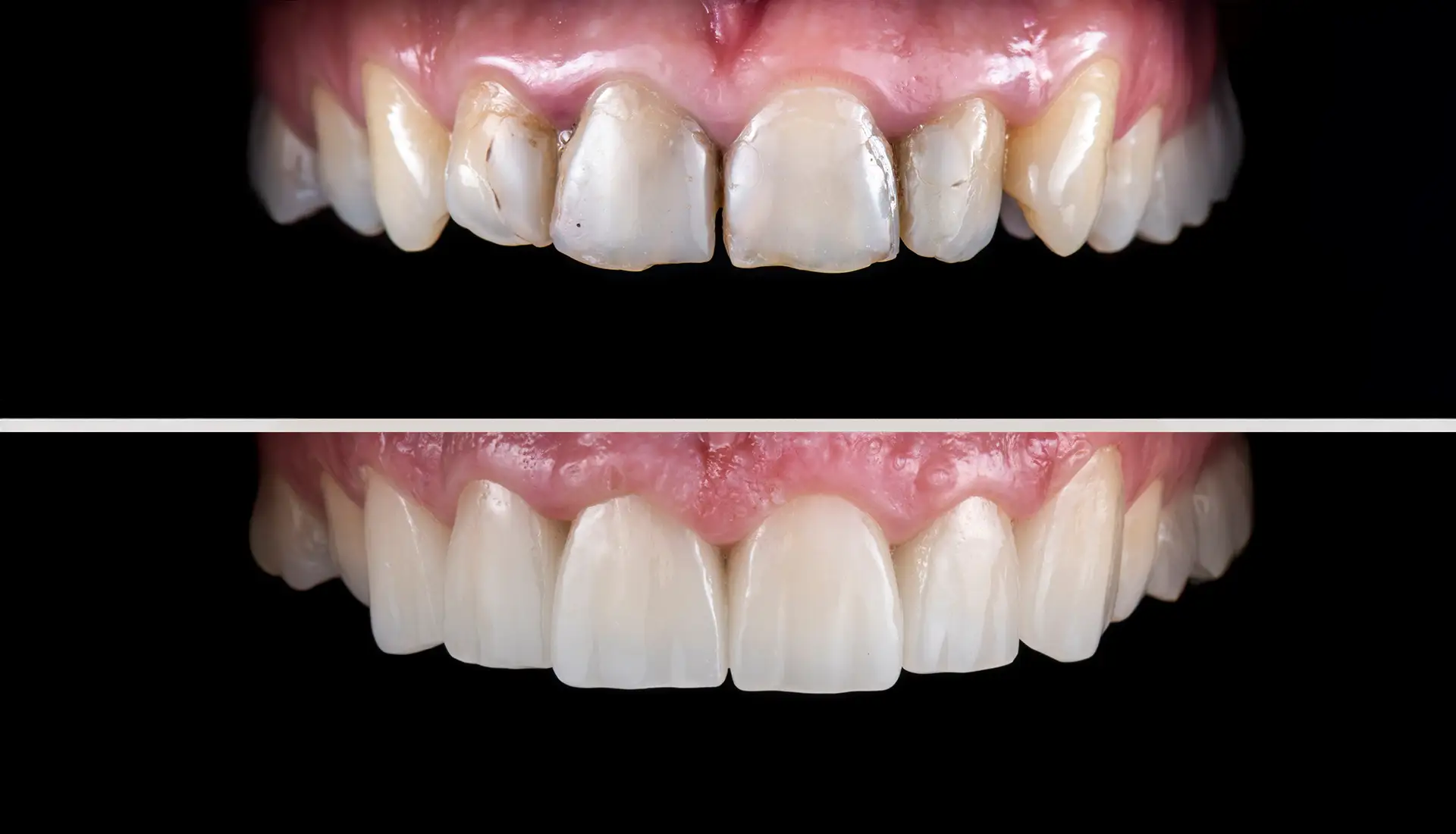 Faccette Dentali - Studio Dentistico a Olbia - Rehabilita - Dott.ri Farre e Tilli Faccette Dentali - Studio Dentistico a Olbia - Rehabilita - Dott.ri Farre e Tilli